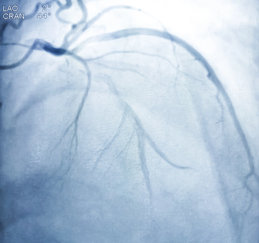 Coronary Angioplasty