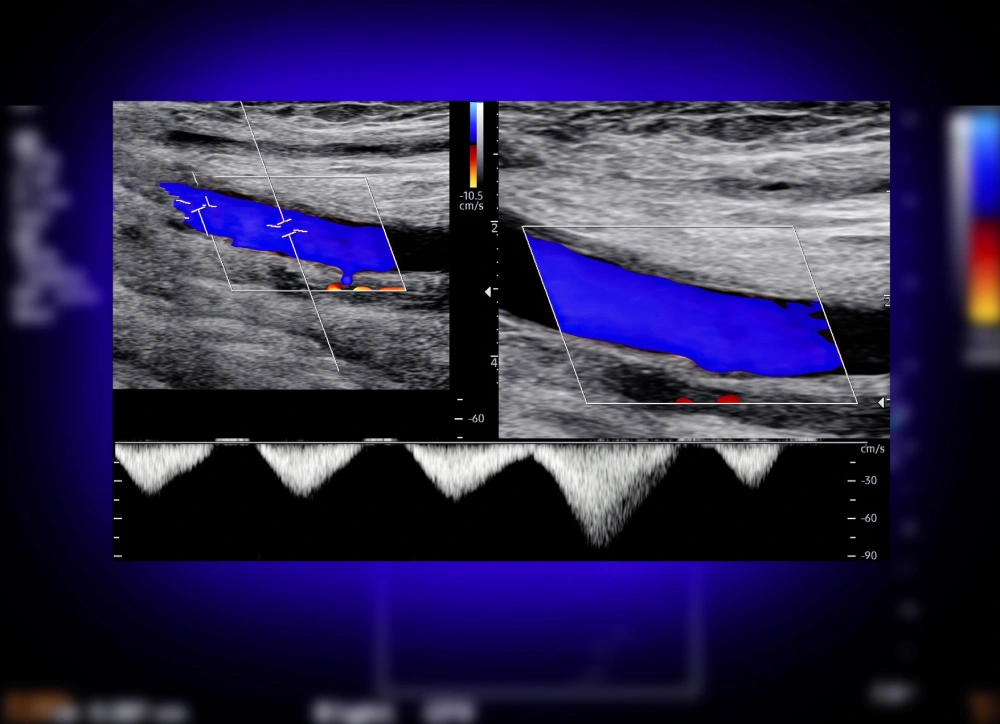 Venous Duplex